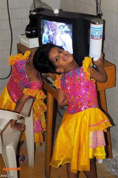 التوأم الهندي الملتصق فاني وفينا في جناح طب الأطفال في مستشفى نايلوفر في حيدر أباد تستعدان لإجراء عملية جراحية لفصلهما.