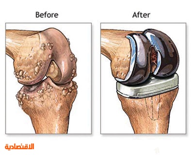 عملية استبدال المفصل الصناعي هي الأكثر أمانا وفاعلية للتخلص من الآلام