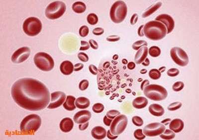 البول الدموي تسببه حصيات الحالب والفحوص الدورية  ضرورية
