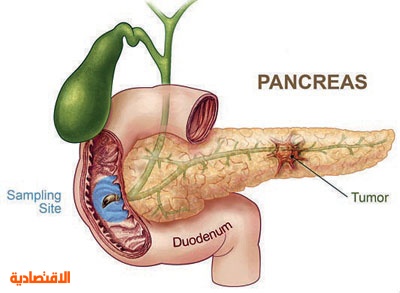 التهابات البنكرياس المزمنة قد تؤدي للإصابة بالأورام