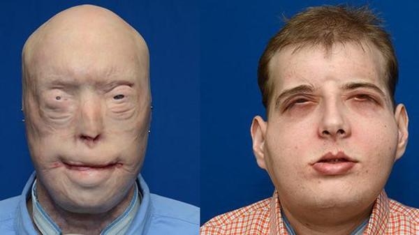 أول جراحة من نوعها في العالم لزرع وجه بالكامل لرجل إطفاء أمريكي