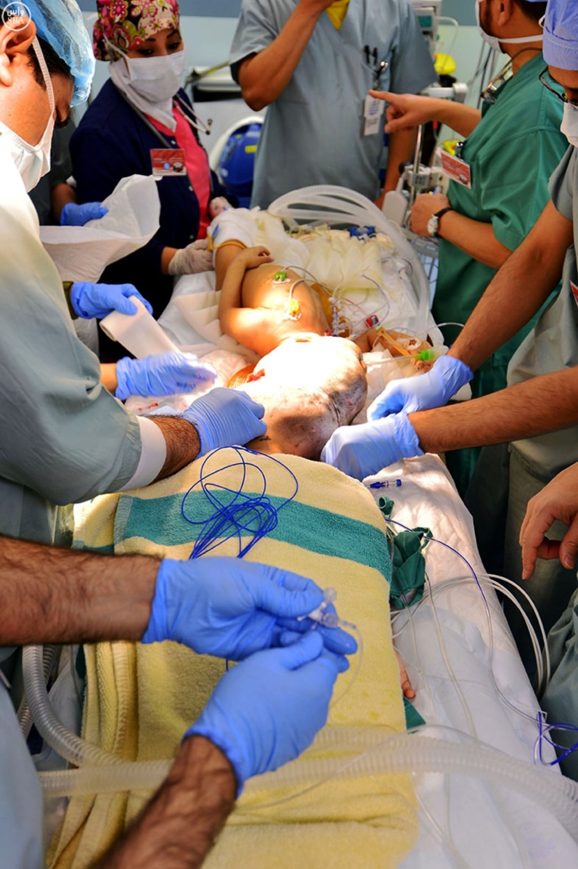 بدء عملية فصل التوأم السوري" تقى ويقين" بمستشفى الملك عبدالله التخصصي للأطفال