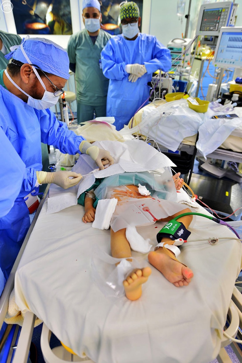 بدء عملية فصل التوأم السوري" تقى ويقين" بمستشفى الملك عبدالله التخصصي للأطفال