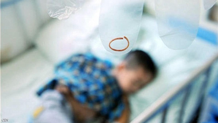 شريط مطّاطي "ينمو" داخل جلد طفل لسنوات