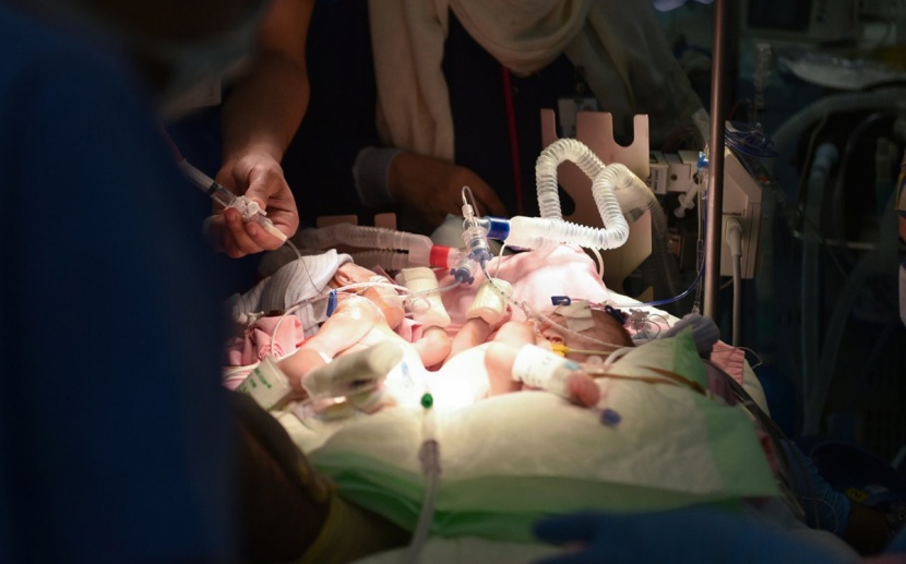 نجاح عملية فصل التوأم السيامي السعودي "ايلين و ايلا"