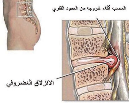 الانزلاق الغضروفي "الديسك" بين فقرات أسفل الظهر.. التشخيص والحلول