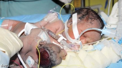 فصل سيامي صومالي في 3 ساعات