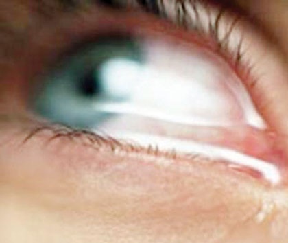 علاج جفاف العين المبكر يقي من المضاعفات الخطيرة ويتم بسرعة وسهولة