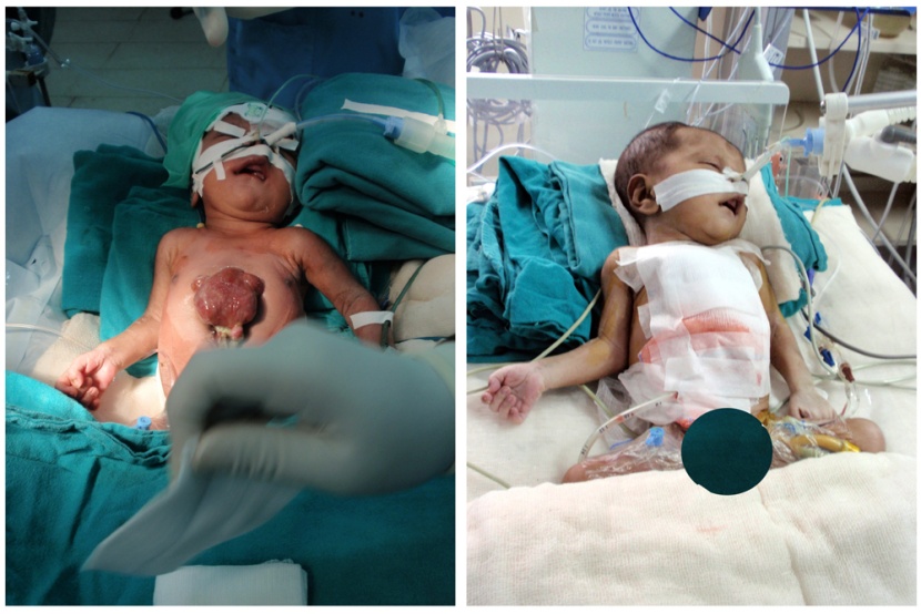صورة مركبة تظهر طفل (10 أيام) في العناية المركزة لمستشفى AIIMS في نيودلهي وهو في حالة مستقرة بعد خضوعه عملية جراحية أسفل رقبته ح
