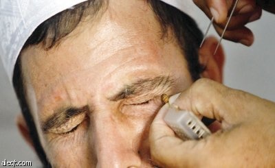 غزة: تهافت المرضى على عيادات العلاج بـ «سم النحل» والرسوم 3 دولارات