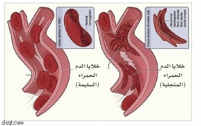 الأنيميا المنجلية خطر بالغ على الأجيال القادمة.. ونسبة الإصابة بها عالية جدا