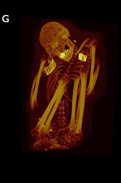 قصة مصورة : اكتشاف اصابة مومياوات من فترات زمنية مختلفة بتصلب في الشرايين