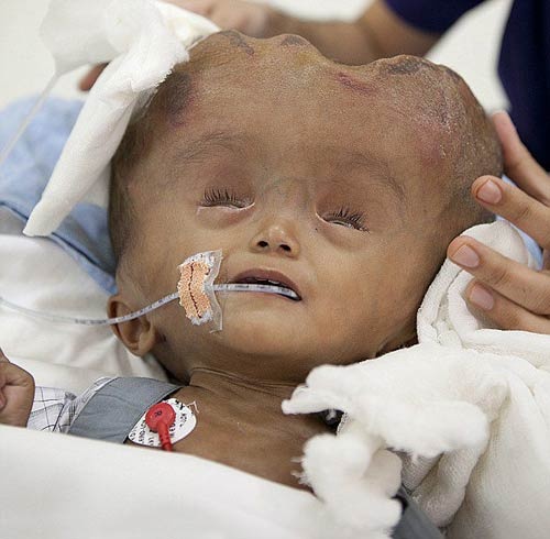 قصة مصورة: تحسن حالة الطفلة الهندية رونا  التى تعاني من زيادة بحجم رأسها