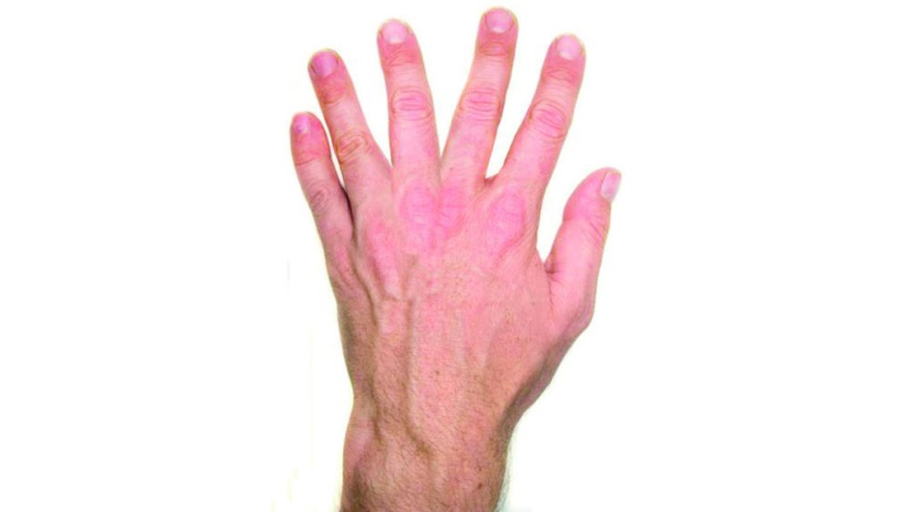 دراسة تدحض الاعتقادات الشائعة حول أصابع اليد الزائدة