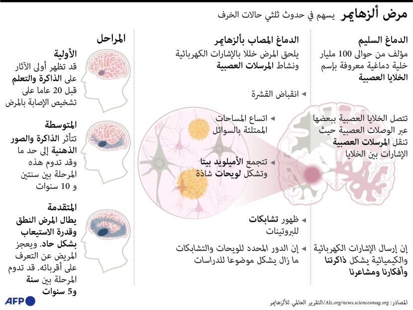 ماهو مرض "ألزهايمر"؟