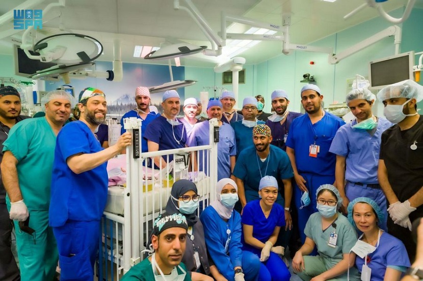 نجاح فصل التوأم السيامي اليمني "يوسف وياسين"  في عملية استغرقت 15 ساعة