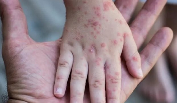 منظمة الصحة تعمل على إرشادات للدول لاحتواء جدري القرود