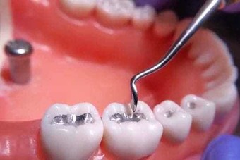 "لا حشو أسنان بعد اليوم".. الطب الصيني يقدم الحل