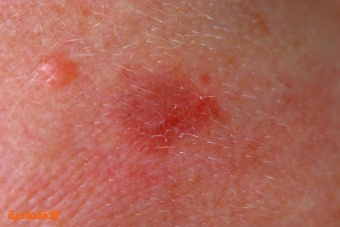 ما أسباب ظهور البقع الحمراء على الجلد وماخطورتها؟